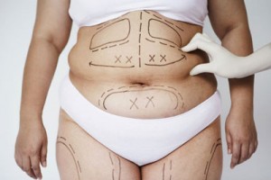 Những câu hỏi thường gặp về phương pháp giảm mỡ bụng nhanh (Phần 1)